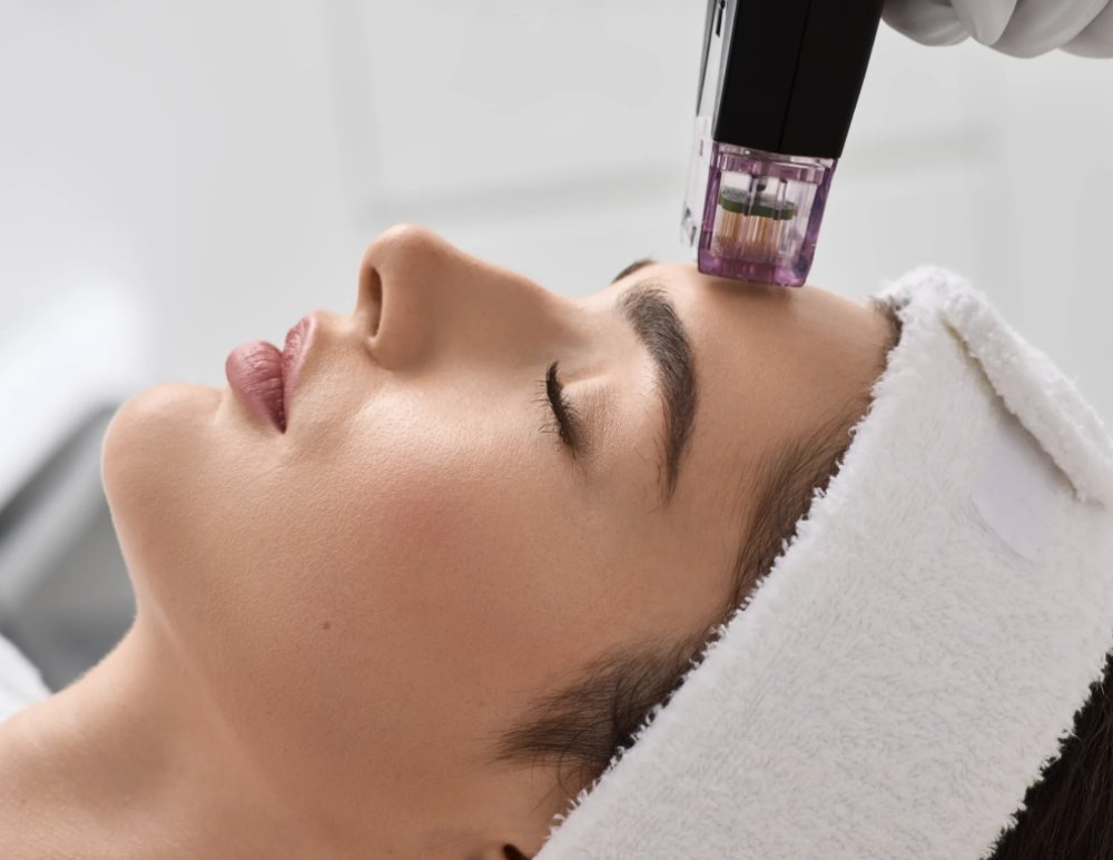 Korean-RF-Microneedling-Potenza