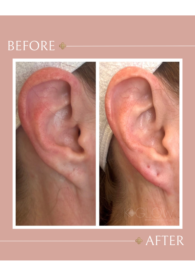 ear-treatment-med-spa