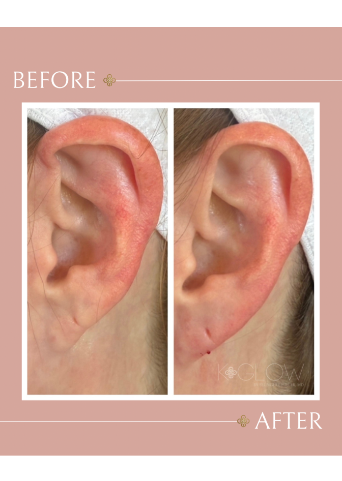 local-md-med-spa-ear