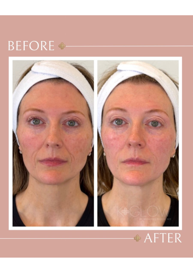 surf-before-and-after-med-spa