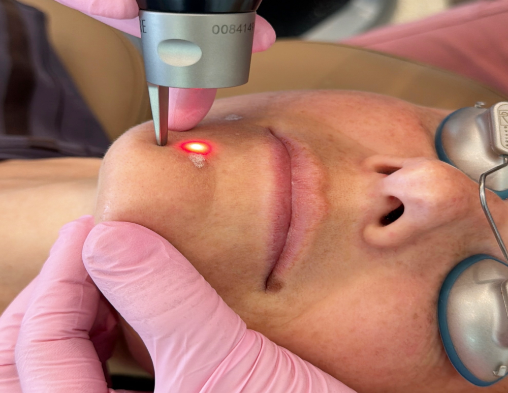PicoSure Pro