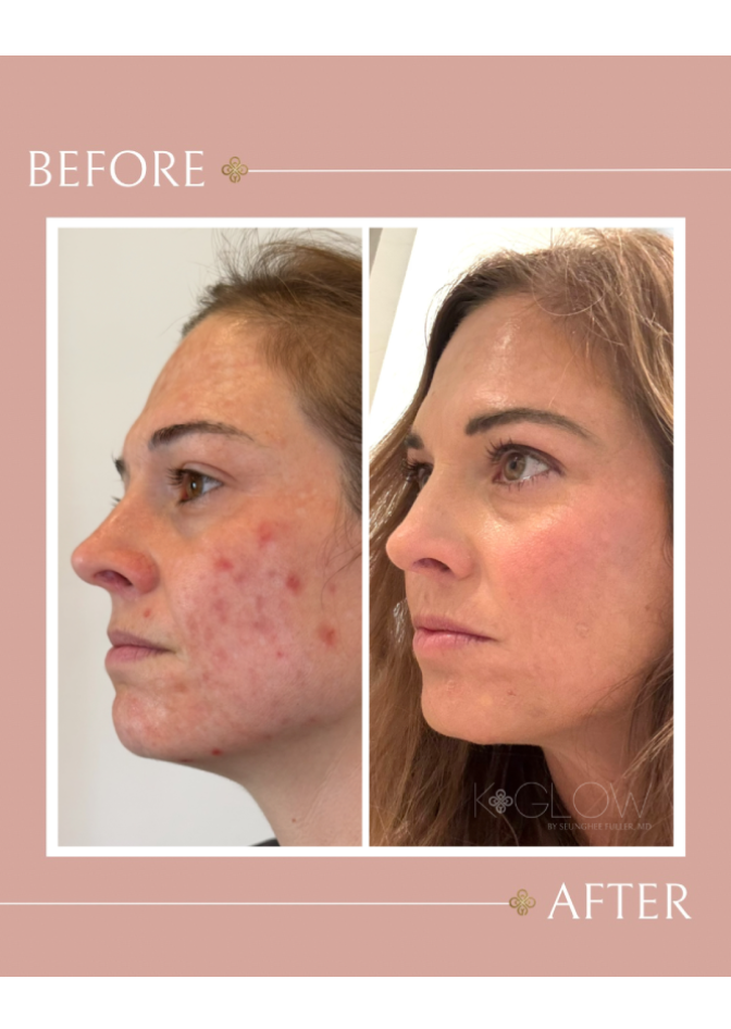 acne-before-and-after