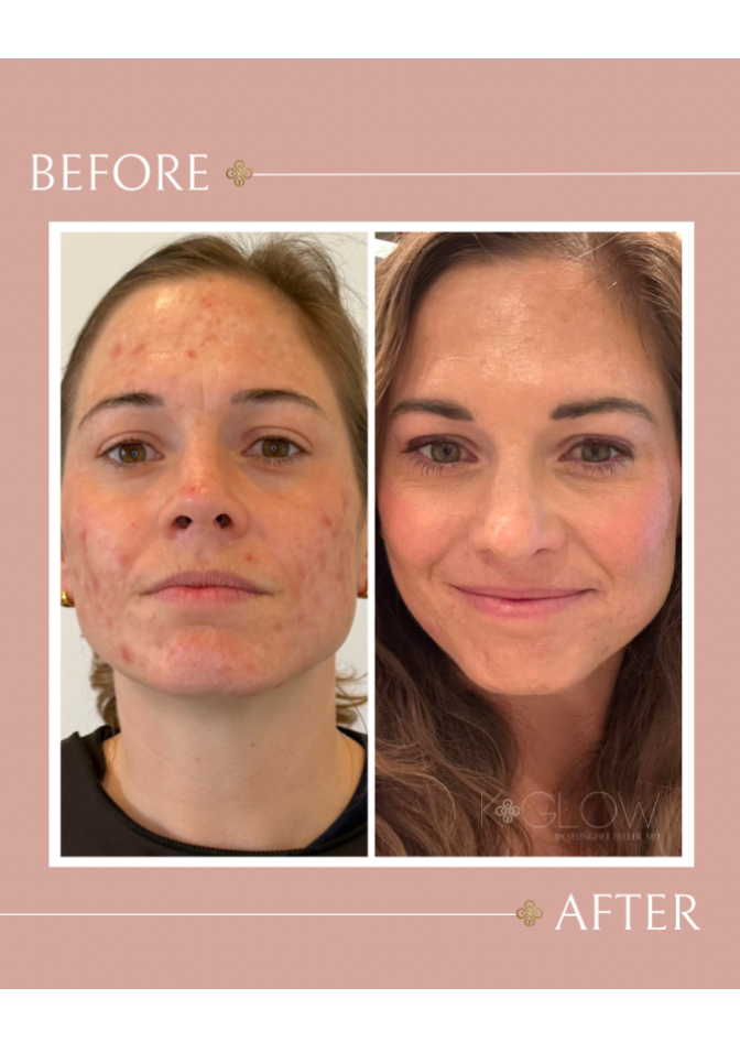 acne-med-spa-treatment