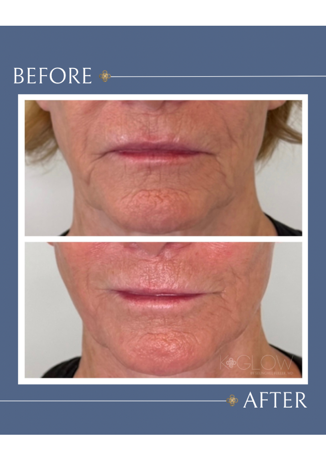lips-treatment