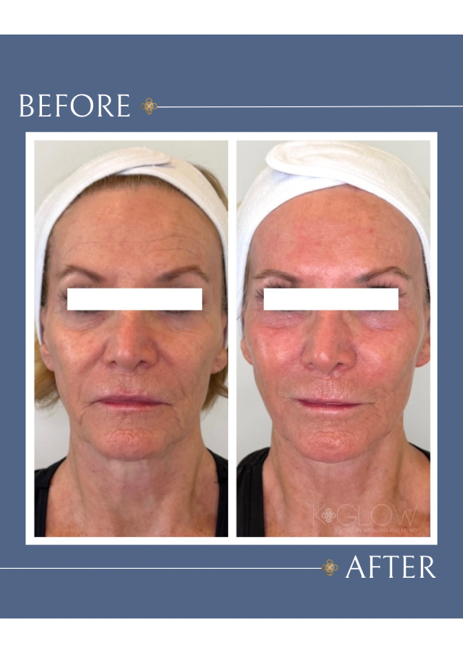 xerf-spa-treatment