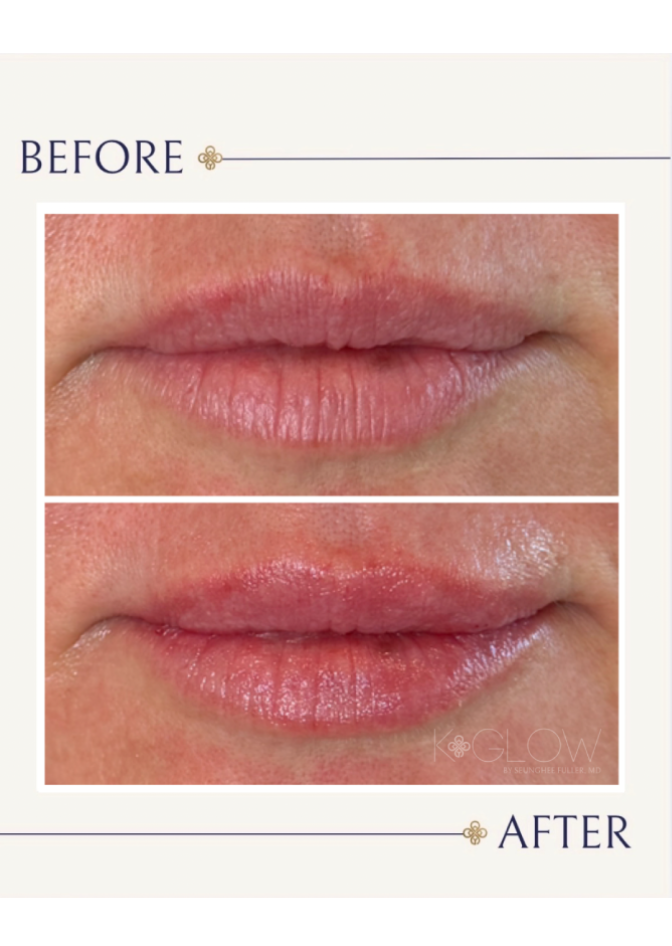 acne-med-spa-treatment