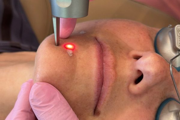 picoSure